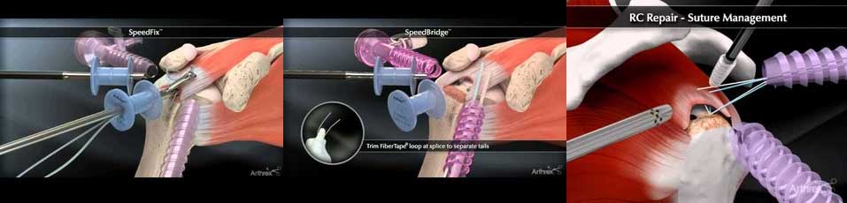 shoulder arthroscopy