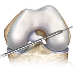 knee ligament reconstruction