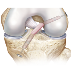 knee ligament reconstruction