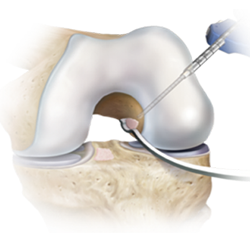 knee ligament reconstruction