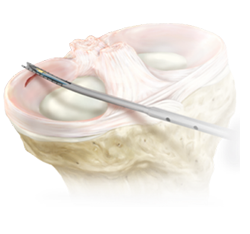 Meniscus Repair Surgery