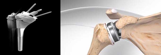 total shoulder replacement